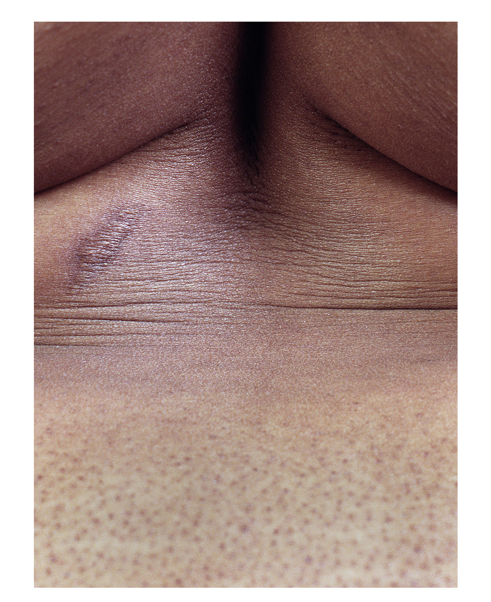 A photograph depicting a close up of a Black woman’s chest, the angle shot from below and including the bottom half of her breasts. There is a scar on the left-hand side of the photograph. 